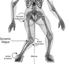 Valgus Collapse